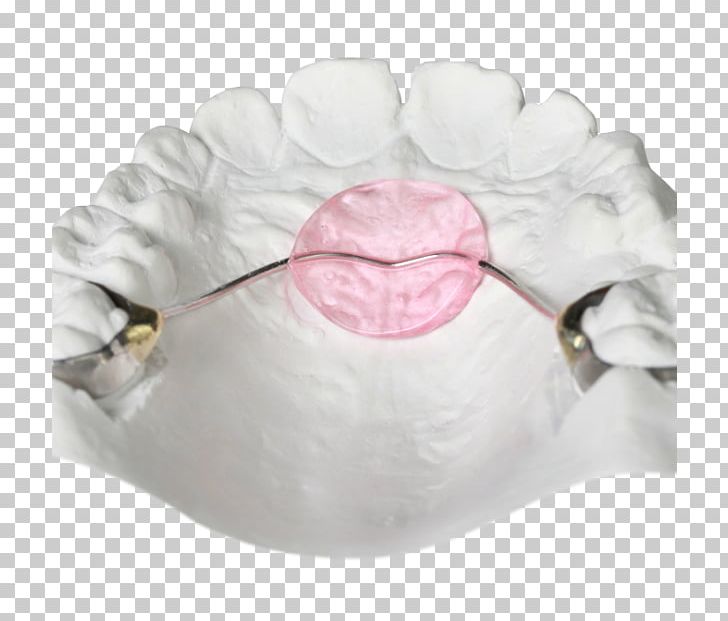 Orthodontics Bionator Jaw Orthodontic Technology Retainer PNG, Clipart, Bed, Bionator, Cots, David Gergen, Home Appliance Free PNG Download