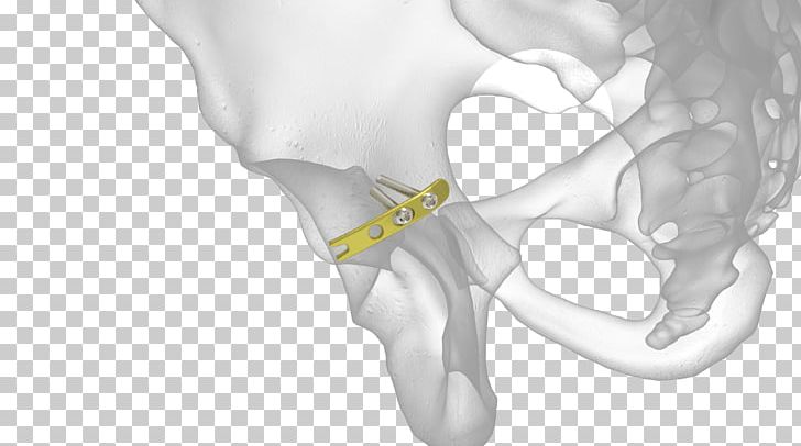 Bone Fracture Acetabulum Acetabular Fracture Radius Pelvic Fracture PNG, Clipart, Acetabulum, Black And White, Bone, Bone Fracture, Distal Radius Fracture Free PNG Download