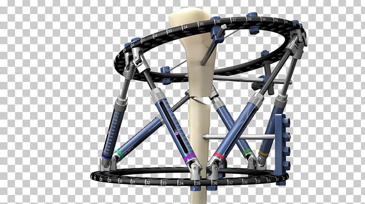 Response Ortho External Fixation Surgery Prosthesis Bone PNG, Clipart, Anatomy, Bicycle Drivetrain Part, Bicycle Fork, Bicycle Frame, Bicycle Part Free PNG Download