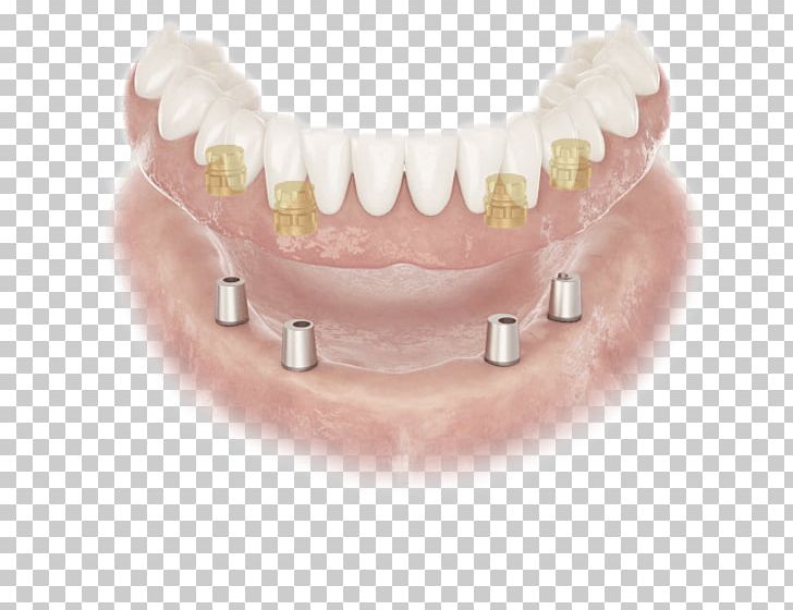 Abutment Dentures Dental Implant Dentist Edentulism PNG, Clipart, Abutment, Allon4, Carestream Health, Crown, Dental Implant Free PNG Download