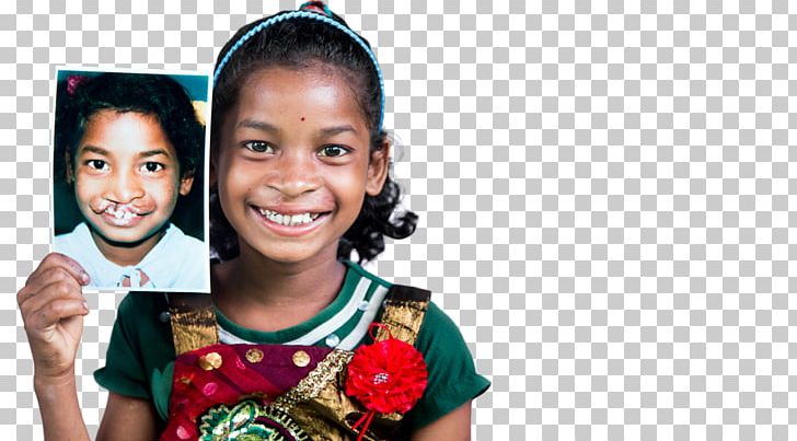 Operation Smile Cleft Lip And Cleft Palate Surgery Hjälporganisation Child PNG, Clipart, Charitable Organization, Child, Cleft Lip And Cleft Palate, Cure, Fashion Accessory Free PNG Download