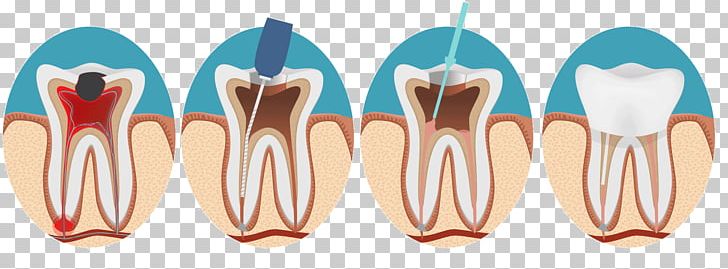 Endodontic Therapy Root Canal Endodontics Dentistry PNG, Clipart, Dental Surgery, Dentist, Dentistry, Endodontics, Endodontic Therapy Free PNG Download