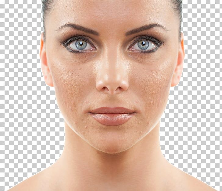 Chemical Peel Exfoliation Facial Skin Photorejuvenation PNG, Clipart, Acne, Beauty, Beauty Parlour, Cheek, Chemical Peel Free PNG Download