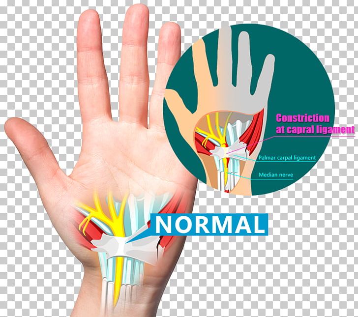 Wrist Pain Carpal Bones Carpal Tunnel Syndrome Ligament PNG, Clipart, Ache, Bone, Carpal Bones, Carpal Tunnel, Carpal Tunnel Syndrome Free PNG Download