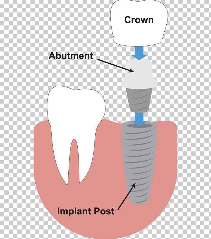 Tooth Dental Implant Dentistry Dentures PNG, Clipart, Angle, Bridge, Dental Extraction, Dental Implants, Dental Surgery Free PNG Download