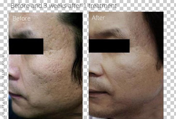 Scar Acne Cheek Surgery Wrinkle PNG, Clipart, Acne, Adverse Effect, Cheek, Chin, Closeup Free PNG Download