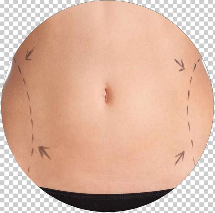 Stretch Marks Abdomen Abdominoplasty Navel Hip PNG, Clipart, Abdomen, Abdominoplasty, Beauty Parlour, Chest, Fat Free PNG Download