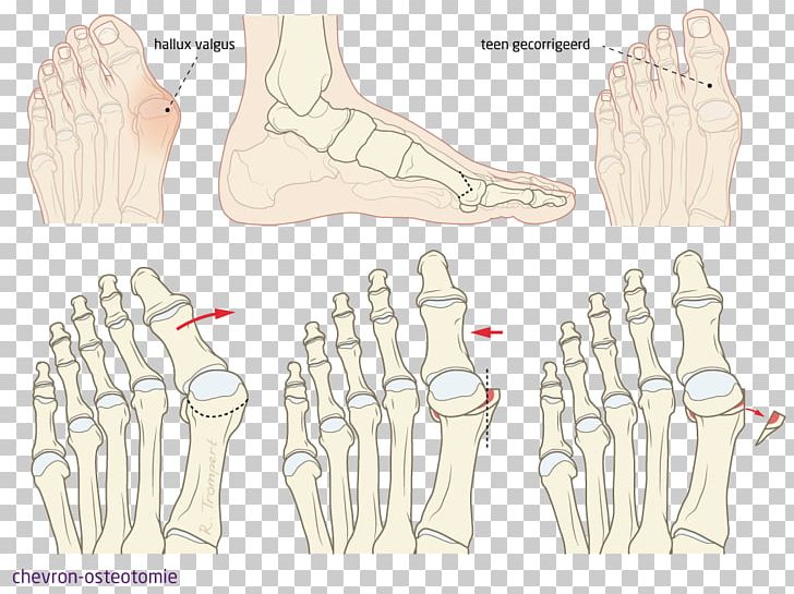 Thumb Hallux Foot Bunion Toe PNG, Clipart, Aandoening, Arm, Bone, Bunion, Diagram Free PNG Download