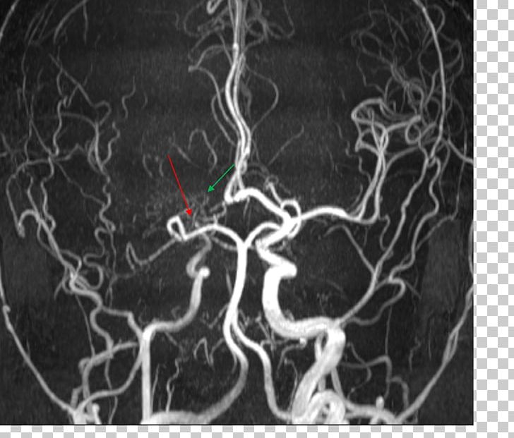 Medical Imaging Magnetic Resonance Angiography Moyamoya Disease Magnetic Resonance Imaging PNG, Clipart, Angiography, Anterior Cerebral Artery, Black, Magnetic Resonance Imaging, Medical Free PNG Download