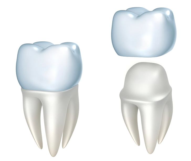 Crown Dentistry Dental Restoration Bridge PNG, Clipart, Bridge, Cosmetic Dentistry, Crown, Dental Implant, Dental Laser Free PNG Download
