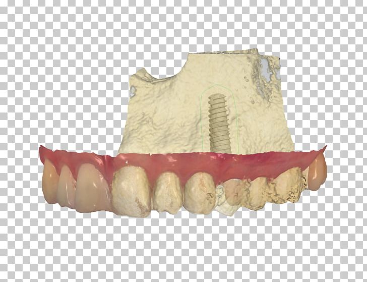 Dental Laboratory Dental Implant Prosthesis Dentistry PNG, Clipart, 3shape, Abutment, Computeraided Design, Dental Implant, Dental Laboratory Free PNG Download