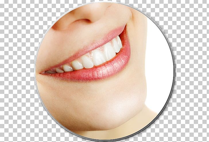 Bleach Tooth Whitening Dentistry PNG, Clipart, Bleach, Bridge, Cartoon, Cheek, Chin Free PNG Download