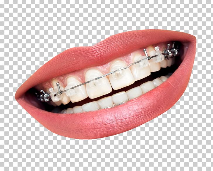 Dental Braces Dentistry Orthodontics Tooth Clear Aligners PNG, Clipart, Braces, Clea, Crown, Dental, Dental Braces Free PNG Download