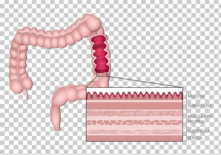 Hereditary Nonpolyposis Colorectal Cancer Large Intestine Colorectal Surgery PNG, Clipart, Anal Cancer, Benign Tumor, Cancer, Colonoscopy, Colorectal Cancer Free PNG Download