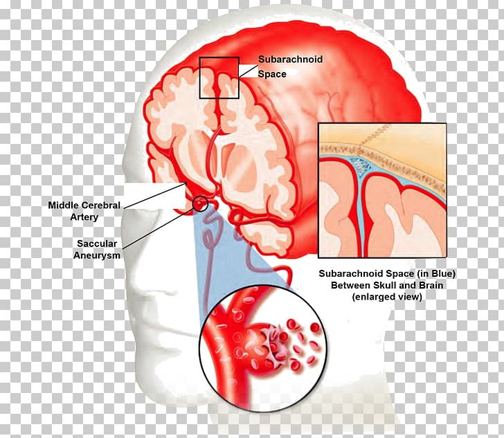 Blood Vessel Stroke Bleeding Brain PNG, Clipart, Bleeding, Blood, Blood Vessel, Brain, Cara Free PNG Download