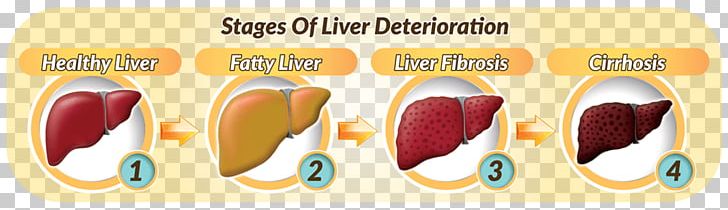 Fatty Liver Dietary Supplement Hepatocyte Liver Disease PNG, Clipart, Cell, Detoxification, Dietary Supplement, Fat, Fatty Liver Free PNG Download