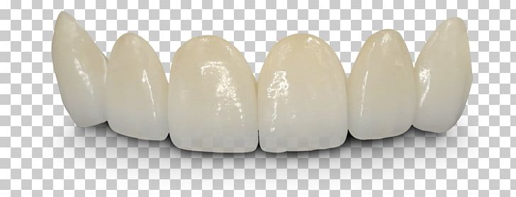 Bridge Crown Dentistry Dentures Tooth PNG, Clipart, Aesthetic, Bridge, Cosmetic Dentistry, Crown, Dental Free PNG Download