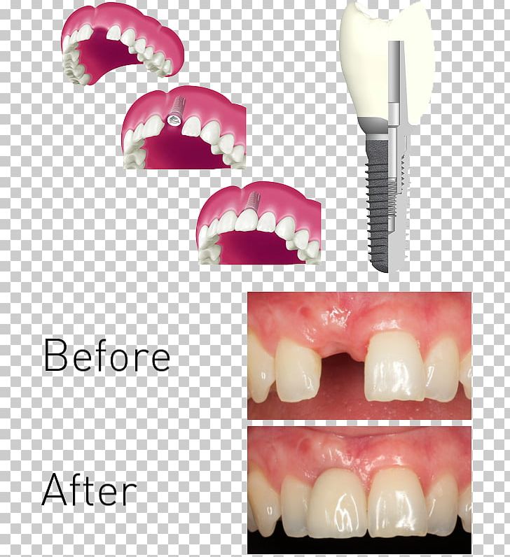 Tooth Dentistry Periodontist Periodontology X-ray PNG, Clipart, Cosmetic Dentistry, Dental, Dentistry, Eyelash, Implant Free PNG Download