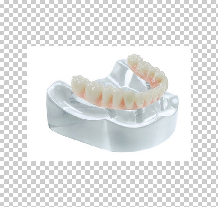 Tooth Bridge Dental Implant Specialty Salvin Dental Specialties PNG, Clipart, Biomaterial, Bone Fracture, Bridge, Crown, Dental Implant Free PNG Download