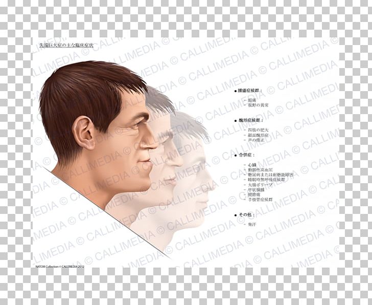 Acromegaly Symptom Gigantism Therapy Medical Sign PNG, Clipart, Acromegaly, Cheek, Chin, Complication, Diabetes Mellitus Free PNG Download
