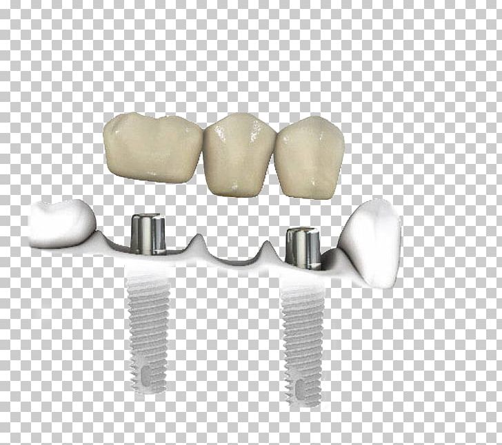 Tooth Dentistry Dental Implant PNG, Clipart, Angle, Biocompatibility, Dental Implant, Dental Implants, Dentist Free PNG Download
