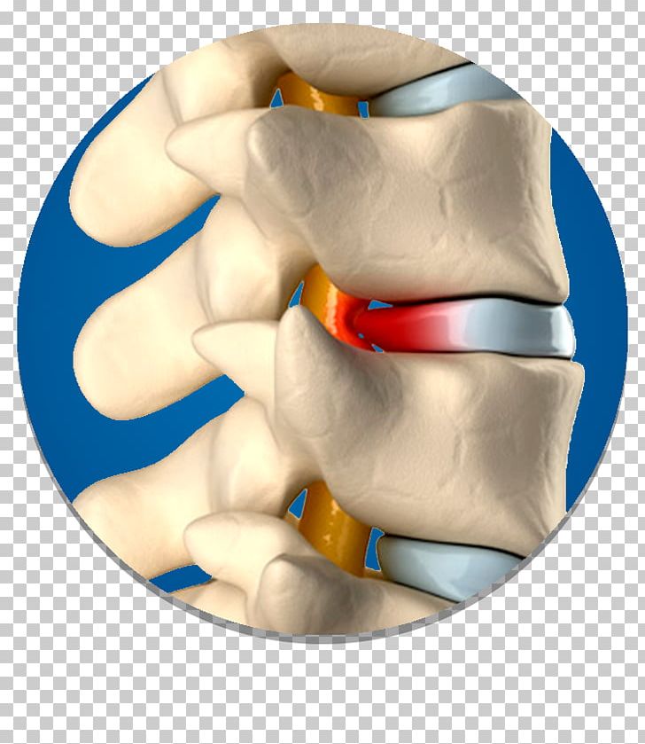 Spinal Disc Herniation Vertebral Column Surgery Intervertebral Disc PNG, Clipart, Ache, Arm, Back Pain, Cervical Vertebrae, Disco Free PNG Download