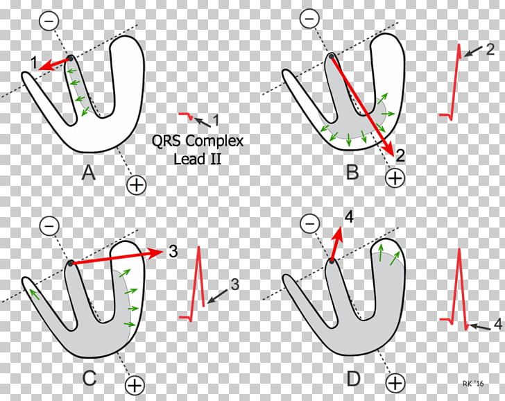 QRS Complex Electrocardiography Heart Depolarization Left Axis Deviation PNG, Clipart, Acute Myocardial Infarction, Angle, Area, Auto Part, Cell Free PNG Download