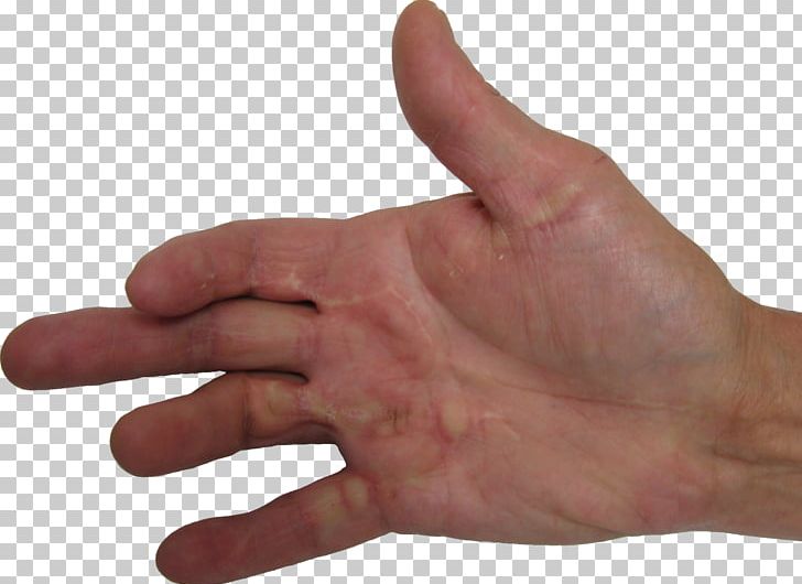 Dupuytren's Contracture Thumb Plantar Fibromatosis Disease Health PNG, Clipart, Arm, Celtic, Contracture, Disease, Exercise Free PNG Download