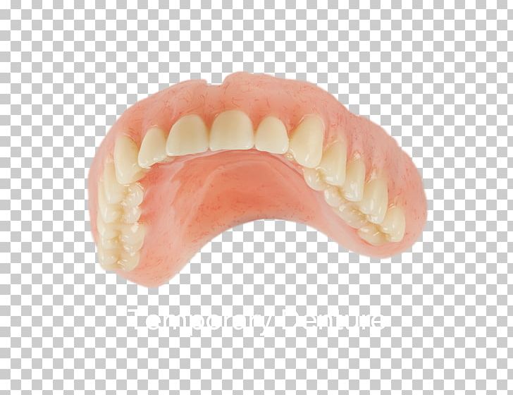 Dentures Human Tooth PNG, Clipart, All On 4, Dentures, Human Tooth, Hybrid, Implant Free PNG Download