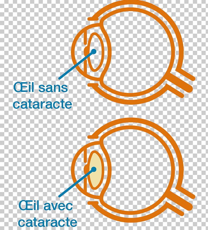 Cataract Graphics Stock Illustration PNG, Clipart, Area, Brand, Cataract, Cataract Surgery, Circle Free PNG Download