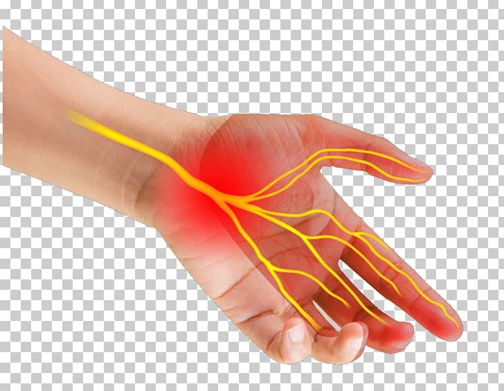 Thumb Carpal Tunnel Syndrome Median Nerve Wrist PNG, Clipart, Carpal Bones, Carpal Tunnel, Carpal Tunnel Syndrome, Compression, Finger Free PNG Download