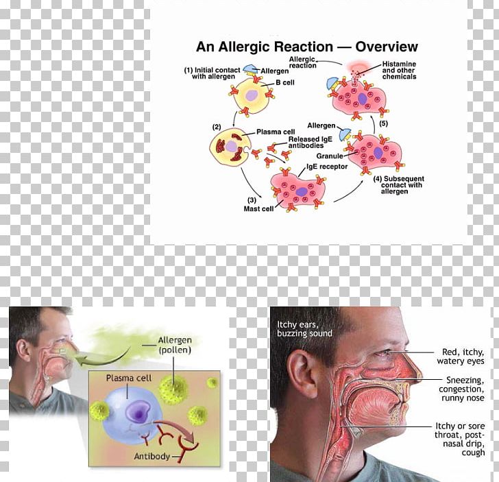 Type I Hypersensitivity Allergy Disease Health PNG, Clipart, Allergy, Antibody, Antigen, Bronchitis, Cheek Free PNG Download