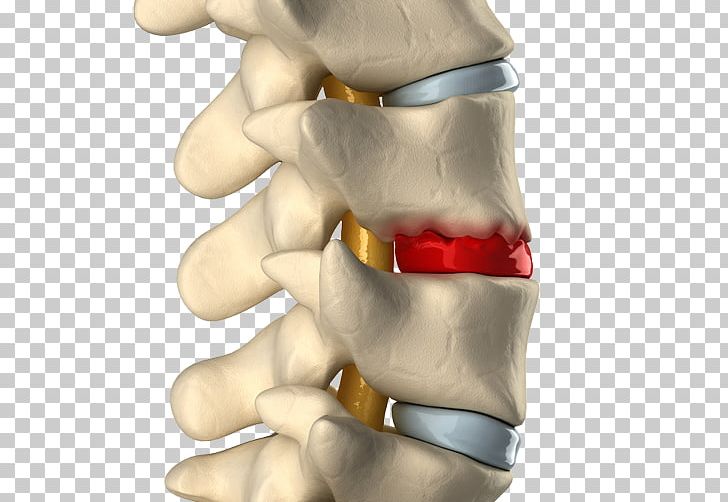 Spinal Disc Herniation Degenerative Disc Disease Intervertebral Disc Vertebral Column Osteophyte PNG, Clipart, Ache, Arm, Back Pain, Chiropractic, Degenerative Disc Disease Free PNG Download