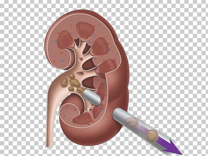 Kidney Stone Surgery Percutaneous Nephrolithotomy Ureter PNG, Clipart, Abdomen, Bladder Stone, Ear, Excretory System, Finger Free PNG Download