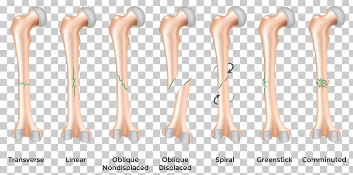 Bone Fracture Diagram Femoral Fracture Femur PNG, Clipart, Arm, Bone, Bone Fracture, Bone Healing, Diagram Free PNG Download