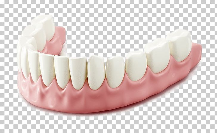 Tooth Alveoloplasty Dentistry Dental Extraction Dentures PNG, Clipart, Cosmetic Dentistry, Dental Extraction, Dentistry, Dentures, Human Tooth Free PNG Download