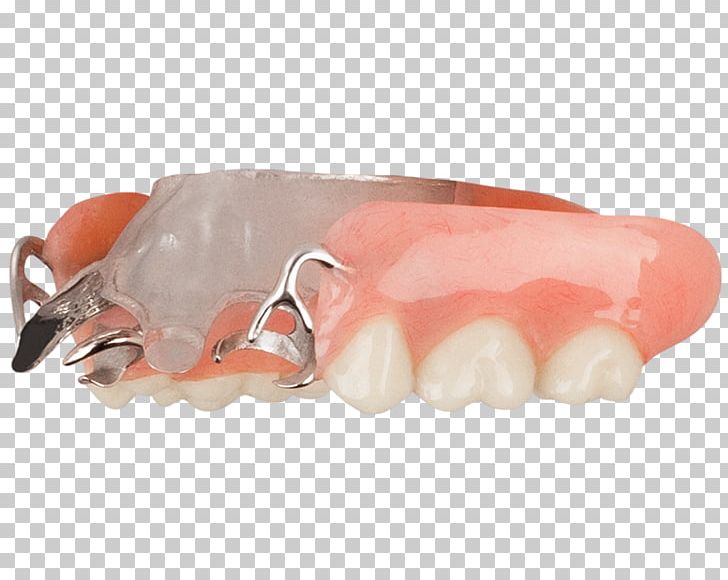 Dentistry Tooth Dentures Aspen Dental Evansville PNG, Clipart, Alcoa, Aspen, Aspen Dental, Dental, Dentistry Free PNG Download