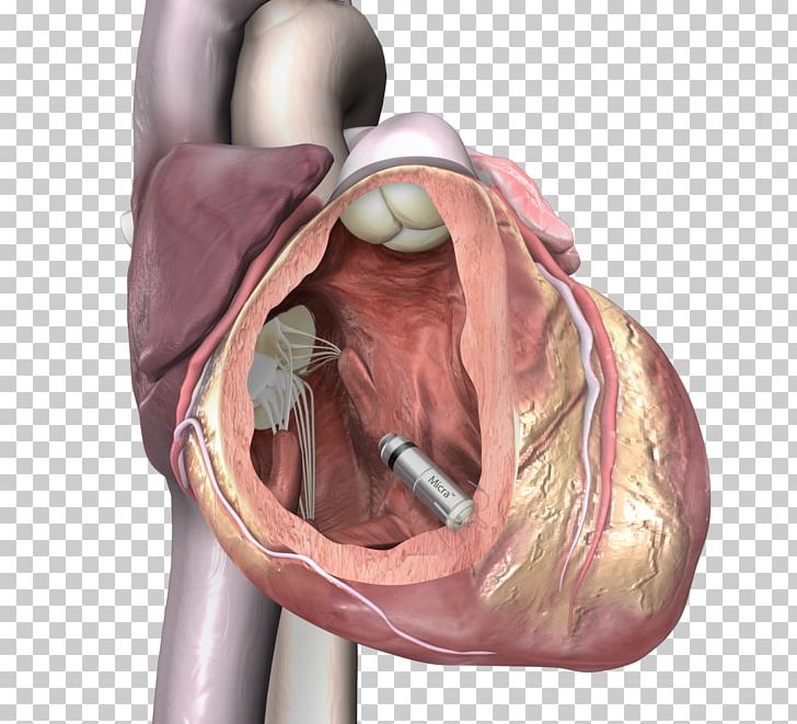 Artificial Cardiac Pacemaker Medtronic Implantable Cardioverter-defibrillator Cardiology PNG, Clipart, Artificial Cardiac Pacemaker, Artificial Heart Valve, Cardiology, Ear, Health Care Free PNG Download