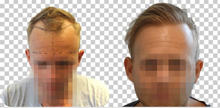 Hair Transplantation Follicular Unit Extraction Eyebrow Hairstyle PNG, Clipart, Cheek, Chin, Ear, Eyebrow, Face Free PNG Download