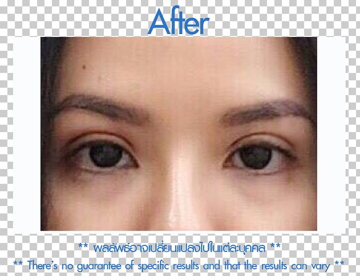 Follicular Unit Extraction Skin Forehead Eyebrow Cheek PNG, Clipart, Botak, Cheek, Chin, Closeup, Eye Free PNG Download