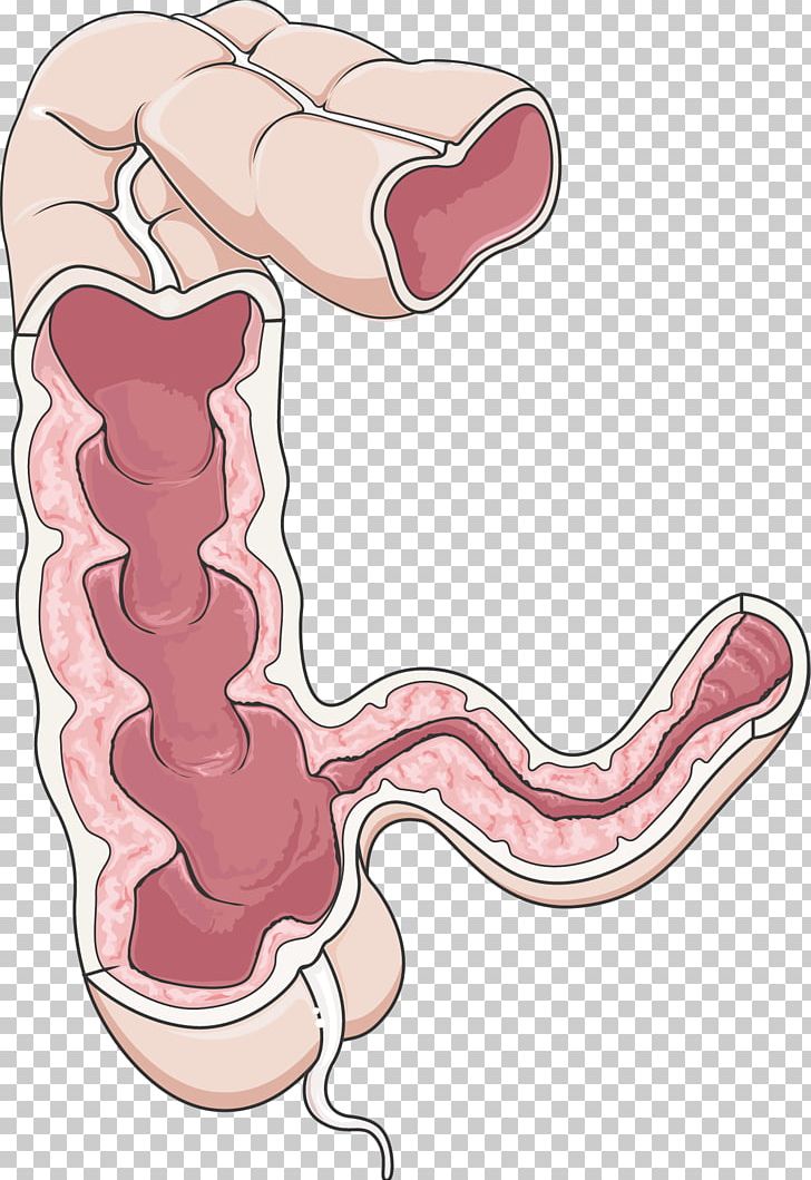 Crohn's Disease Large Intestine Gastrointestinal Tract Inflammatory Bowel Disease PNG, Clipart, Abdomen, Allie, Arm, Autoimmunity, Bea Free PNG Download