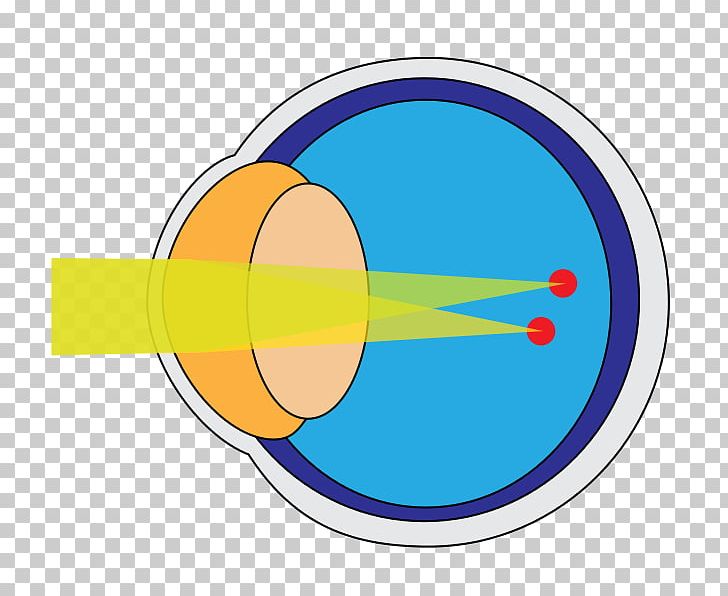 Astigmatism Cornea Eye Disease Near-sightedness PNG, Clipart, Astigmatism, Choroby Oczu, Circle, Contact Lenses, Cornea Free PNG Download