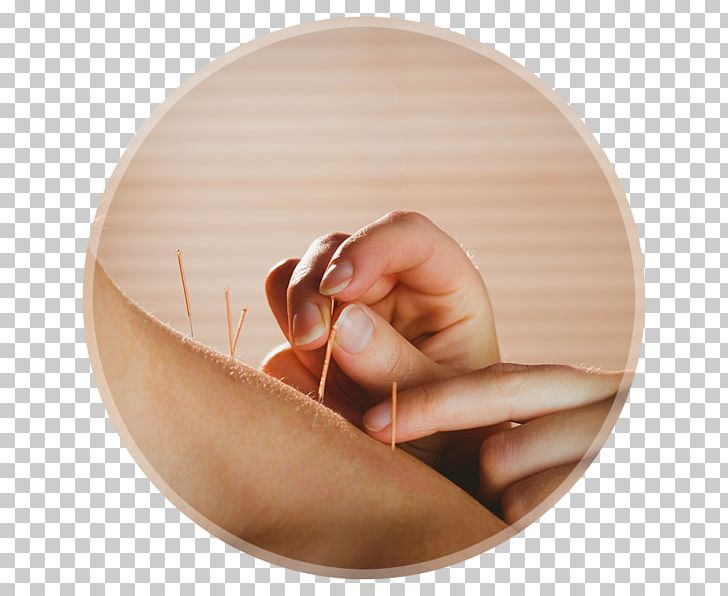 Dry Needling Myofascial Trigger Point Acupuncture Myotherapy Myofascial Release PNG, Clipart, Ache, Acupuncture, Anxiety, Copper, Cupping Therapy Free PNG Download