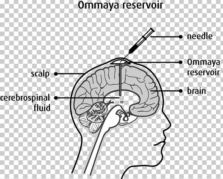 Ommaya Reservoir Intrathecal Administration Chemotherapy Cancer Brain Tumor PNG, Clipart, Angle, Brain, Brain Tumor, Breast Cancer, Canadian Cancer Society Free PNG Download