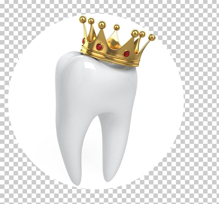Crown Dentistry Human Tooth PNG, Clipart, Antler, Body Jewelry, Bridge, Cadcam Dentistry, Cosmetic Dentistry Free PNG Download