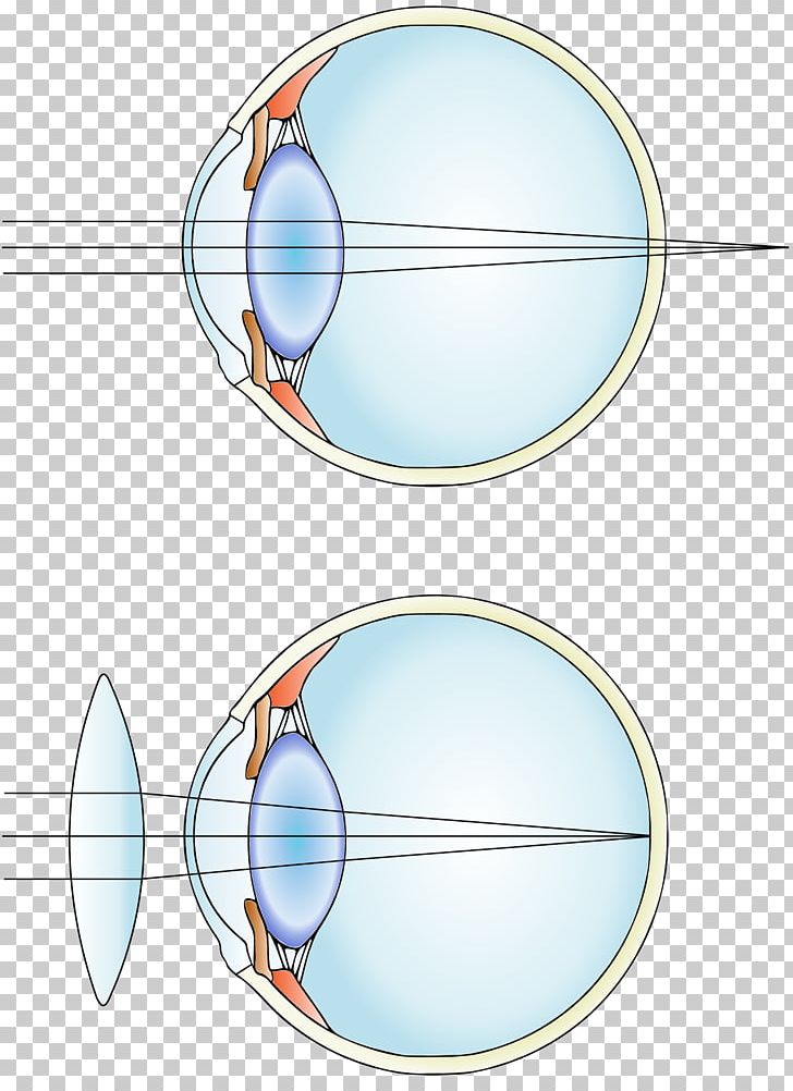 Near-sightedness Hypermetropia Corrective Lens Astigmatism Refractive Surgery PNG, Clipart, Amblyopia, Angle, Area, Astigmatism, Circle Free PNG Download