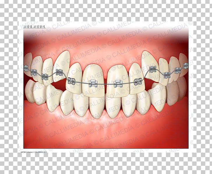 Tooth Dentistry Dental Braces Orthodontics Medicine PNG, Clipart, Cosmetic Dentistry, Dental Braces, Dental Care, Dentistry, Disease Free PNG Download