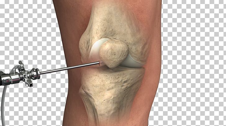 Orthopedic Surgery Knee Lipogems International SpA Therapy PNG, Clipart, Healing, Joint, Knee, Muscle, Neck Free PNG Download