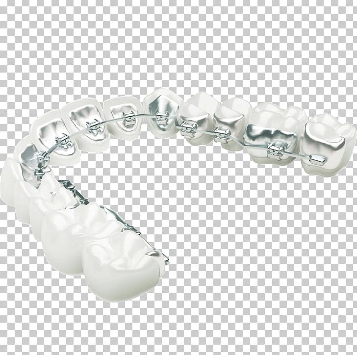 Lingual Braces Orthodontics Dental Braces Clear Aligners Orthodontic Technology PNG, Clipart, Body Jewelry, Bracelet, Braces, Cosmetic Dentistry, Crystal Free PNG Download