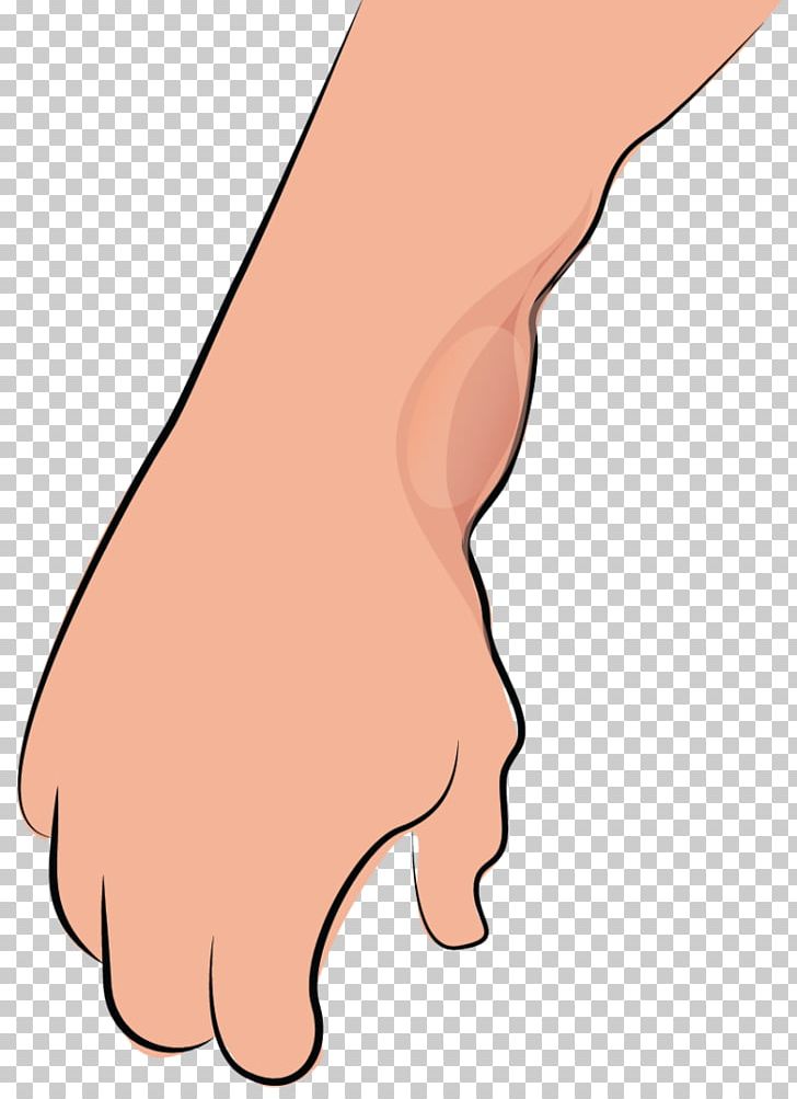 Thumb Synovial Cyst Surgery Tendon PNG, Clipart, Abdomen, Arm, Cyst, Finger, Foot Free PNG Download